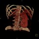 Duplex kidney: CT - Computed tomography